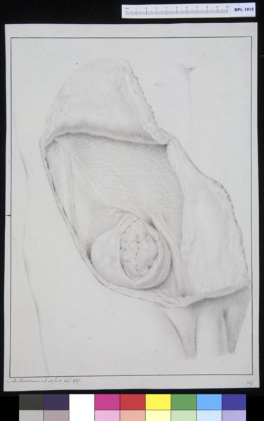 M Houtman, Hernia inguinalis