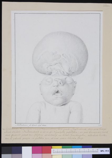 M Houtman, Deformed fetus