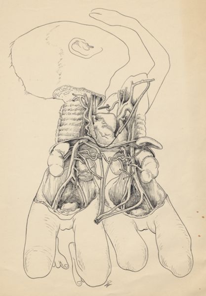 J Tinkelenberg, Heart and circulatory system of conjoined twins