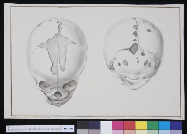 M Houtman, Two views of a skull with fractures