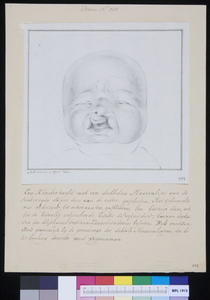 M Houtman, Child with cleft lip
