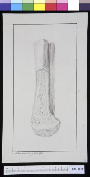 M Houtman, Infected bone (tibia?)