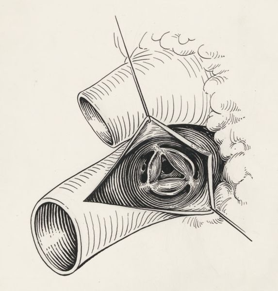 J Tinkelenberg, Thorax surgery