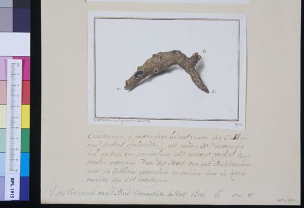 M Houtman, Gallstones