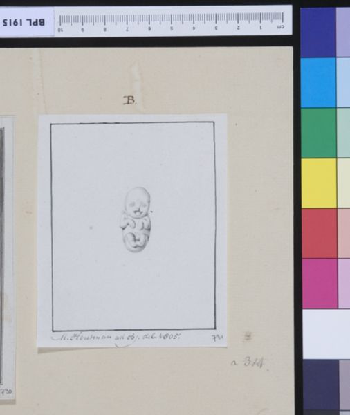M Houtman, Fetus with cleft lip