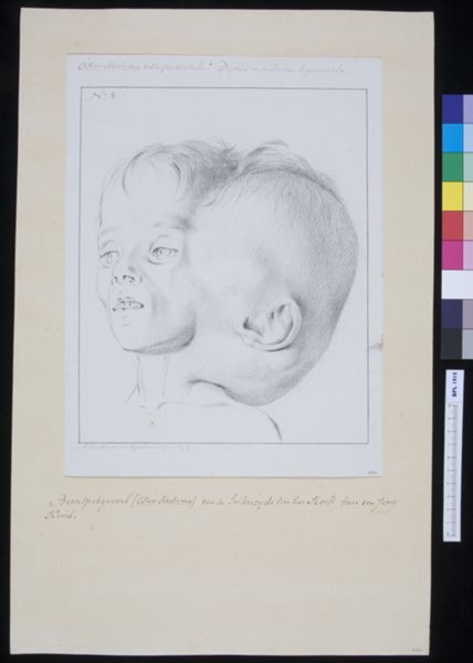 M Houtman, Osteo-steatoma in a child's head