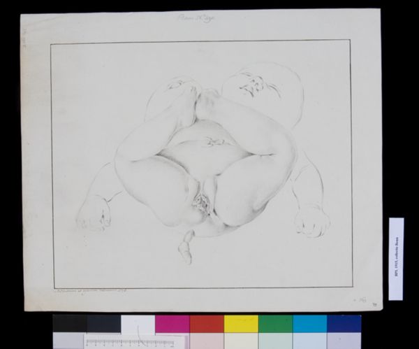 M. Houtman, Conjoined twins