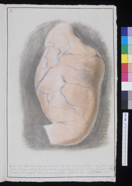 A Bonn, Swelling on a girl's arm