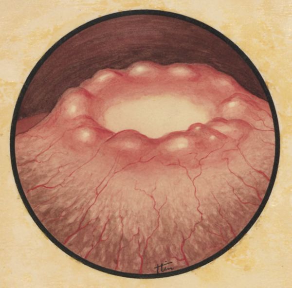 J Tinkelenberg, Microscopic magnification of an inflammation on human tissue