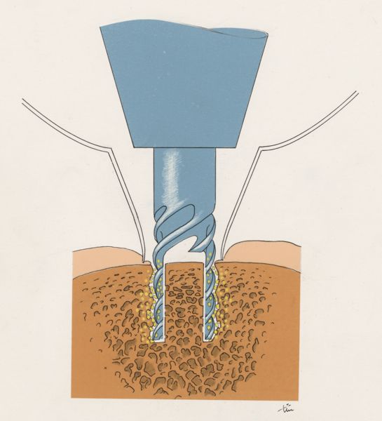 J Tinkelenberg, Bone drilling technique