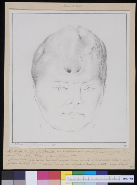 M. Houtman, Ms Cornelis Bardue, a patient suffering from loss of bone structure