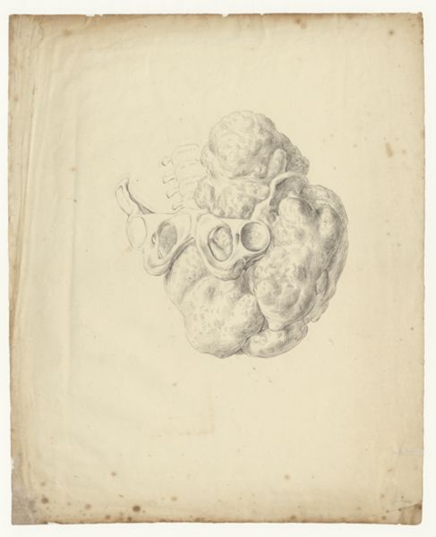 A Bonn, Tumor growing from a man's buttocks, attached to the pelvis