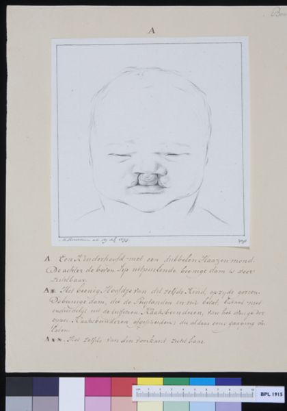 M Houtman, Head of a child with cleft palate