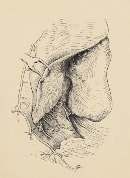 J Tinkelenberg, Part of the heart and circulatory system