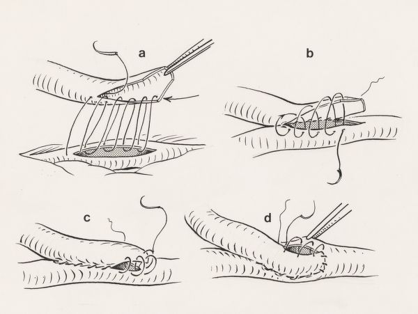 J Tinkelenberg, Thorax surgery