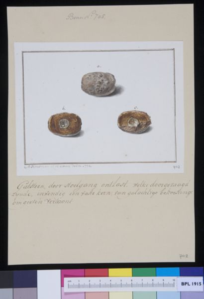 M Houtman, Gallstones