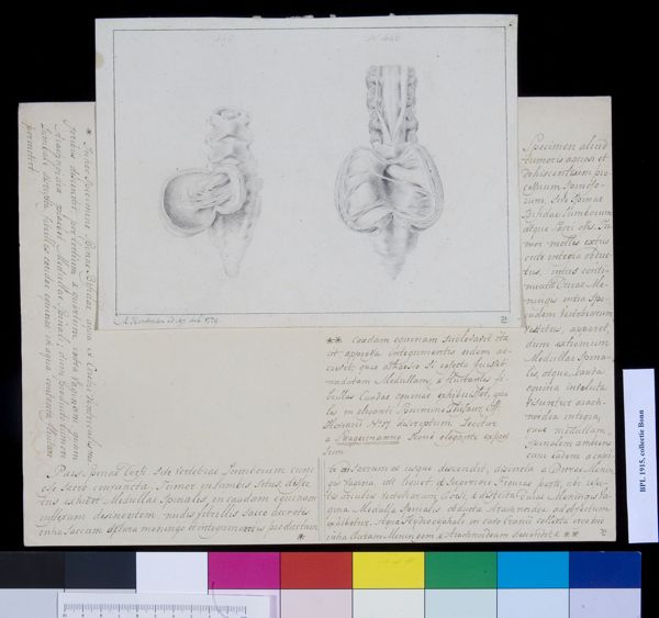 M Houtman, Spina bifida