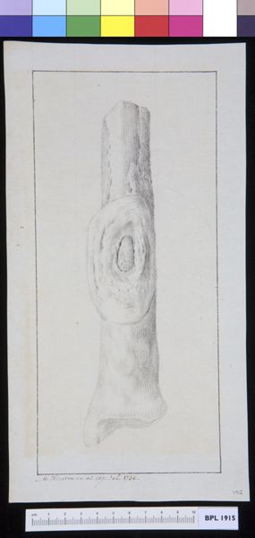 M Houtman, Infected bone (tibia?)