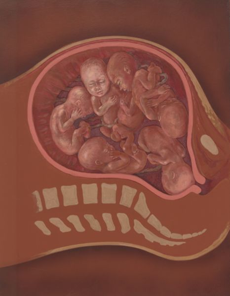 J. Tinkelenberg, Sextuplets in the womb