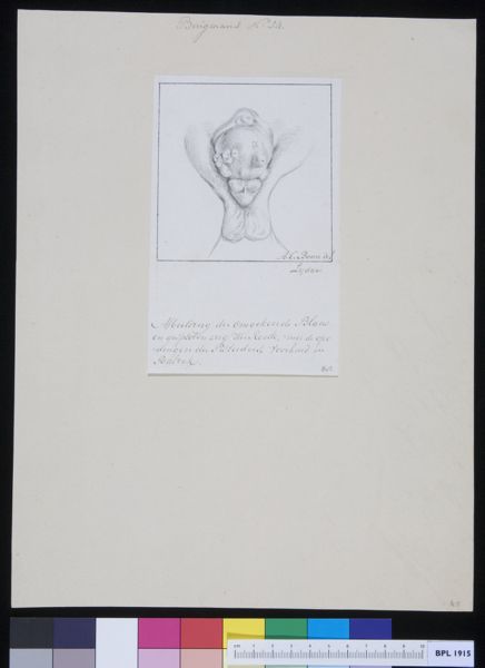 A Bonn, Male genitals, deformed