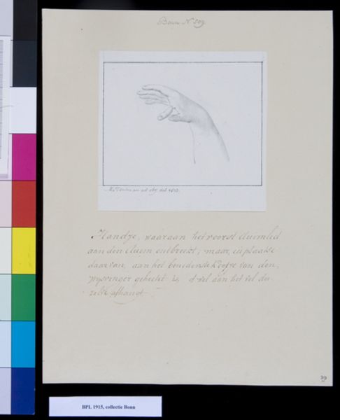 M. Houtman, hand with incomplete thumb and extra finger