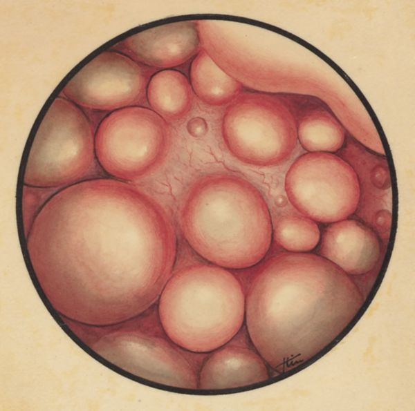 J Tinkelenberg, Embryonic heart