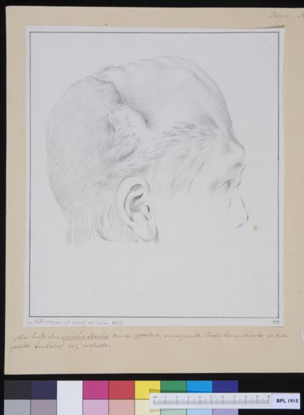 M. Houtman, Ms Cornelis Bardue, a patient suffering from loss of bone structure