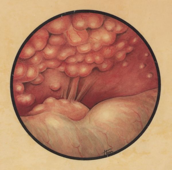 J Tinkelenberg, Embryonic heart