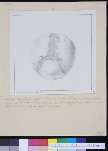 M Houtman, Skull of a child with hydrocephalus