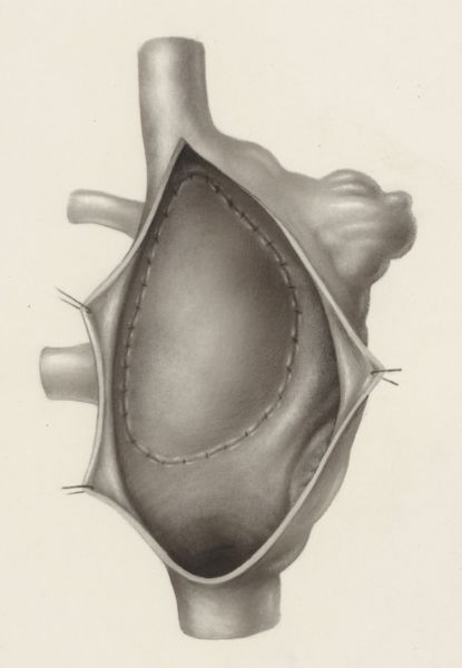 J Tinkelenberg, Thorax surgery