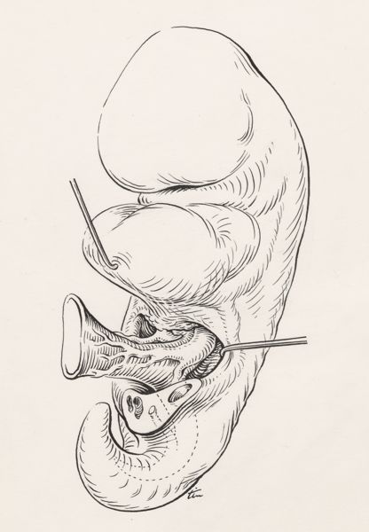 J Tinkelenberg, Human embryo