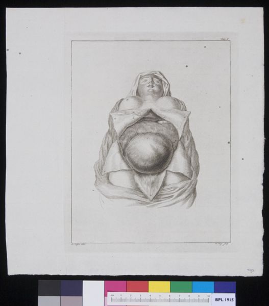 R Muys, Pregnant woman with openend abdomen