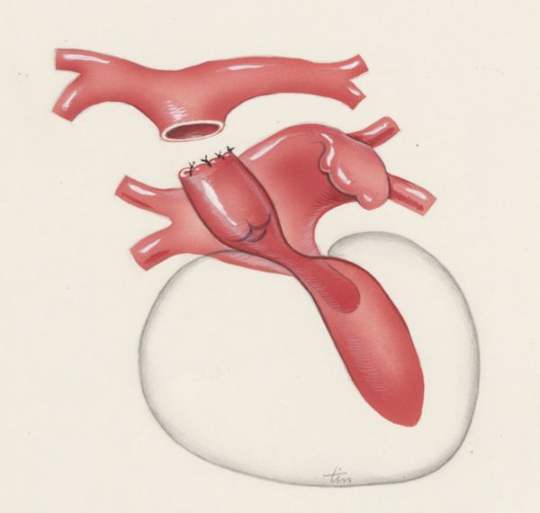 J Tinkelenberg, Thorax surgery