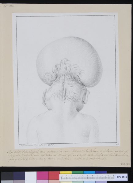 M Houtman, Deformed fetus