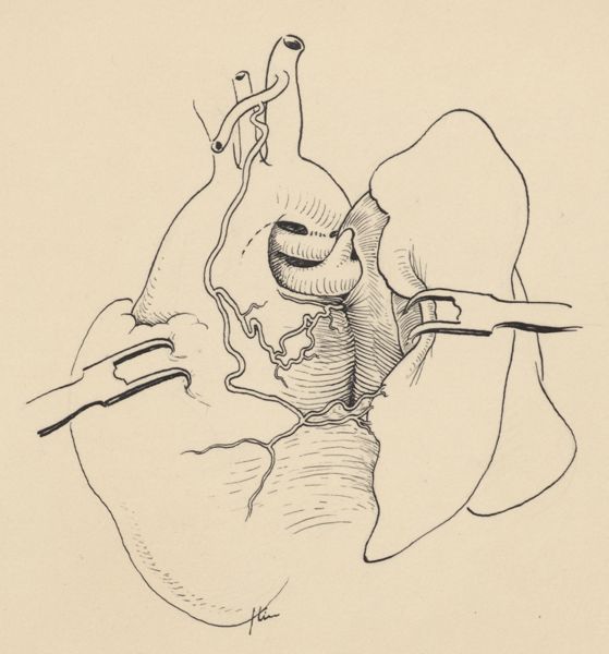 J Tinkelenberg, Embryonic heart
