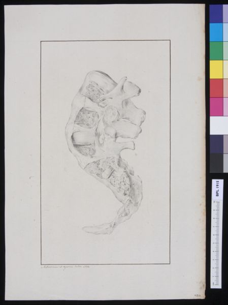 M Houtman, Torsioned vertebrae