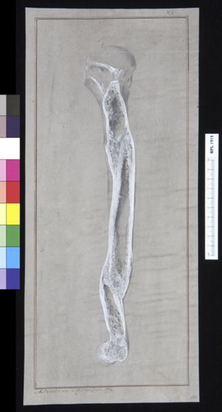 M Houtman, Infected bone