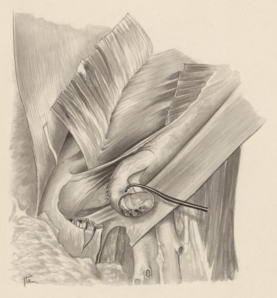 J Tinkelenberg, Tissue of the inguinal