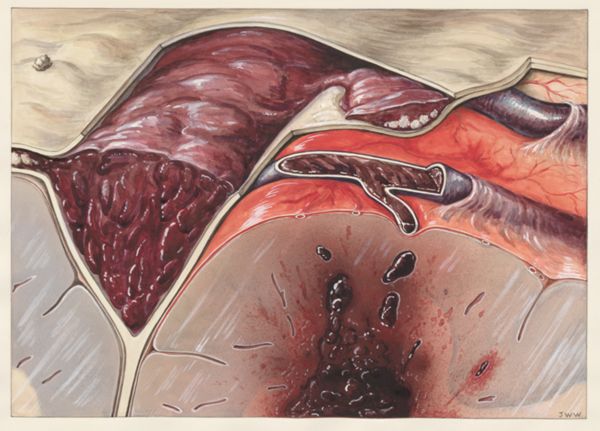 J Wetselaar-Whittaker, Sick human tissue relating to thrombosis