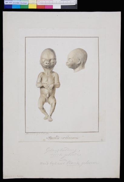 M Houtman, Foetus of a child from Suriname