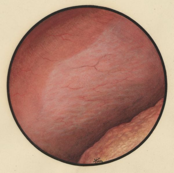 J Tinkelenberg, Microscopic magnification of the abdomen
