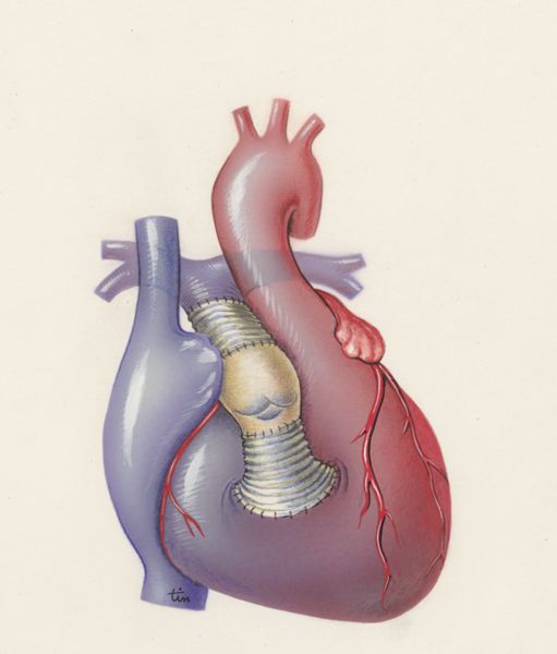 J Tinkelenberg, Thorax surgery