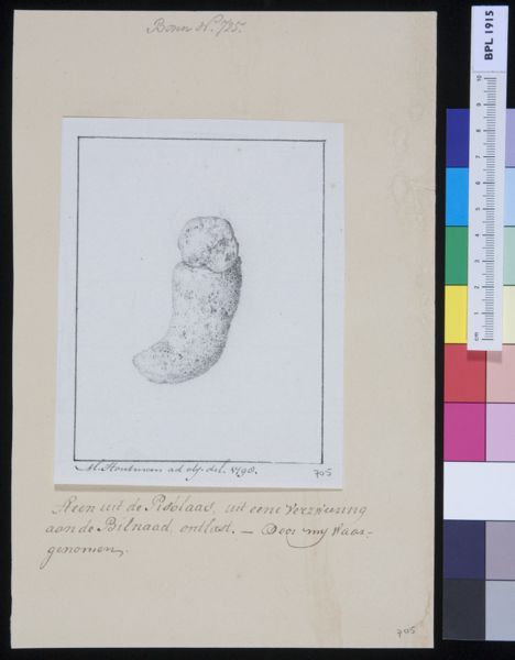 M Houtman, Stone from the bladder