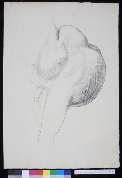 A Bonn, Man with a tumor growing from his buttocks