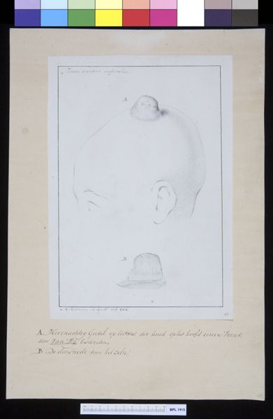 M Houtman, Tumor on top of woman's head