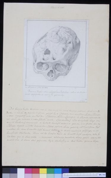 M. Houtman, Skull of Ms Cornelis Bardue, a patient suffering from loss of bone structure
