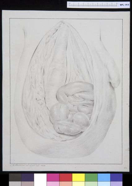 M. Houtman, Hernia inguinalis