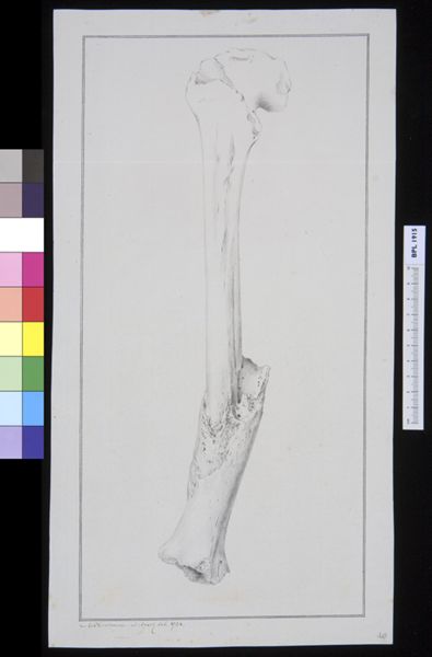 M Houtman, Infected bone (femur?)