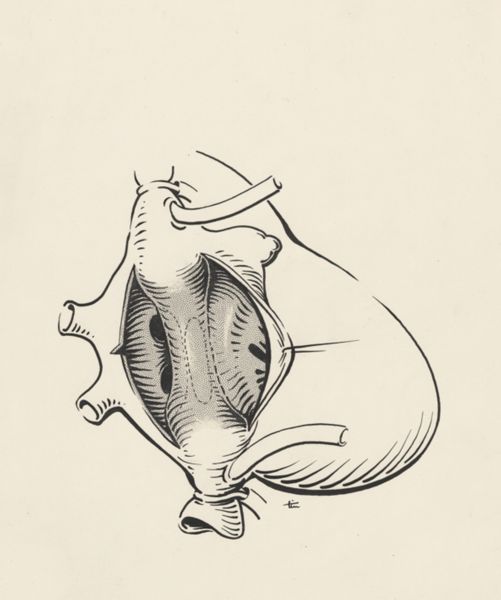 J Tinkelenberg, Heart surgery