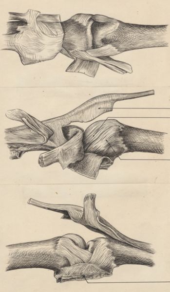 J Tinkelenberg, Joints of the hand or fingers